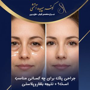 جراحی پلک برای چه کسانی مناسب است؟ نتیجه و ماندگاری بلفاروپلاستی