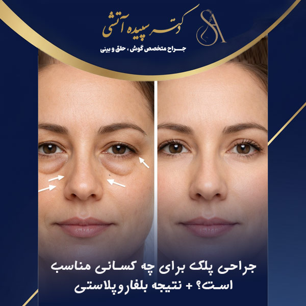 جراحی پلک برای چه کسانی مناسب است؟ نتیجه و ماندگاری بلفاروپلاستی